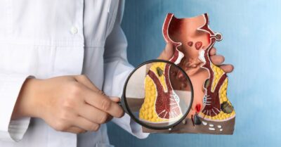 Colonoscopy Singapore