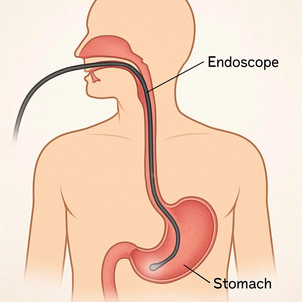 endoscopy (gastroscopy) diagram